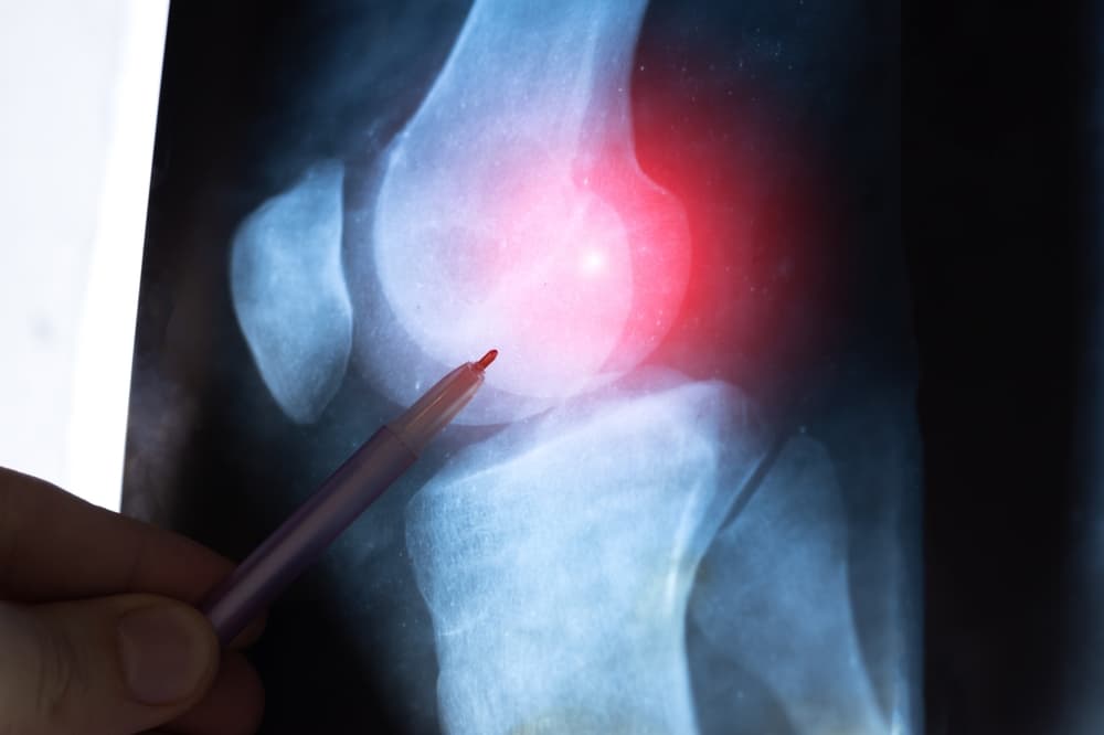 Diagnostic of Knee joint pathology, detected, such fracture, destruction, osteoarthritis.